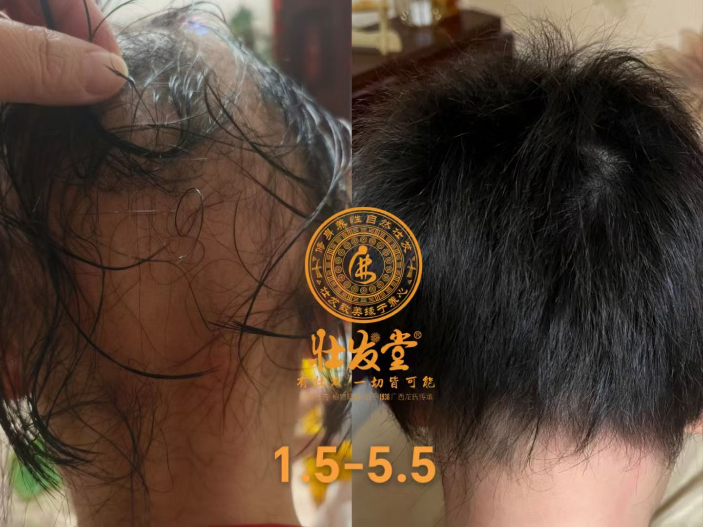 内蒙9岁女孩，之前缺发部位已长满