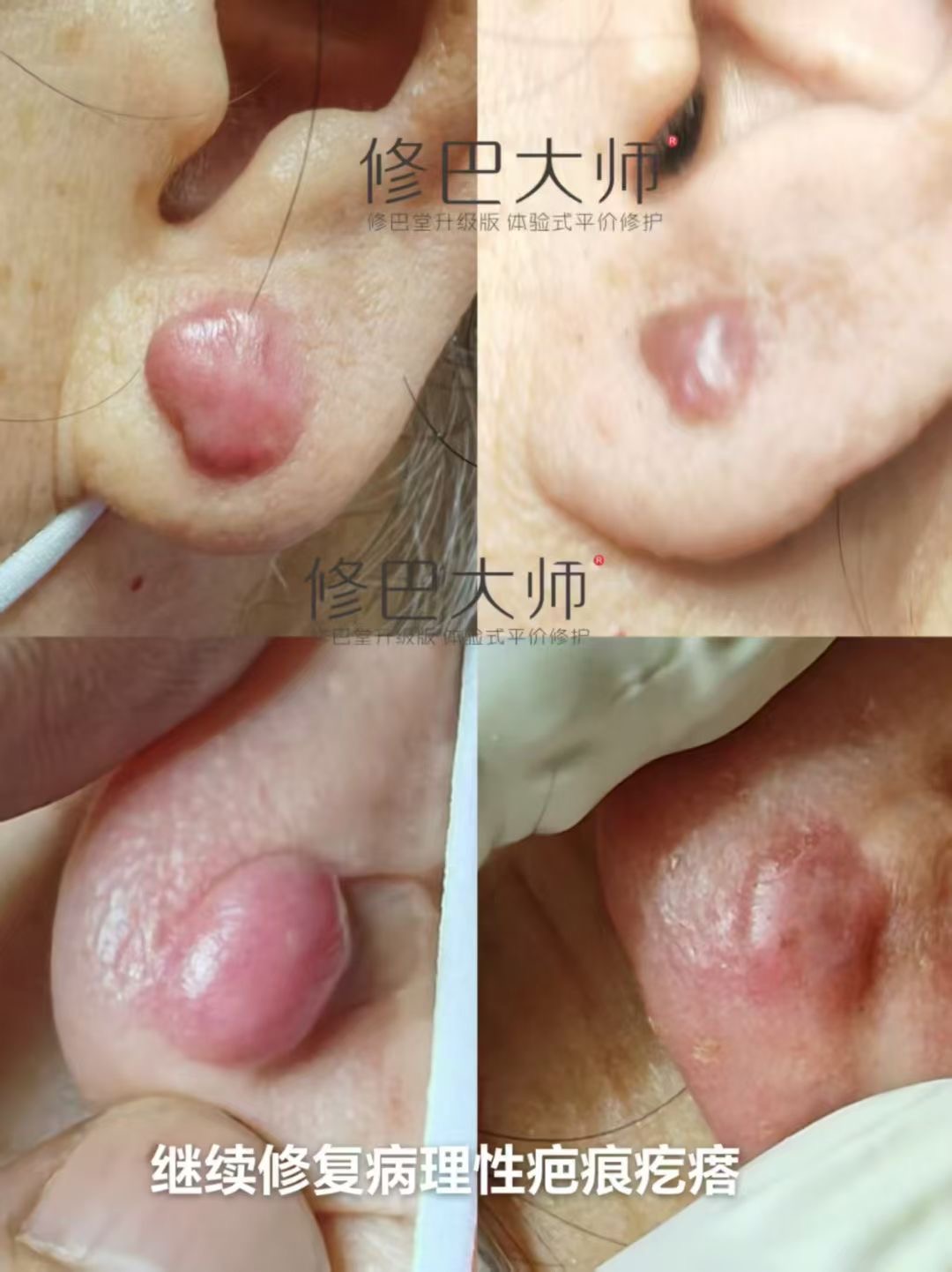 病理性疤痕疙瘩修复，效果很好